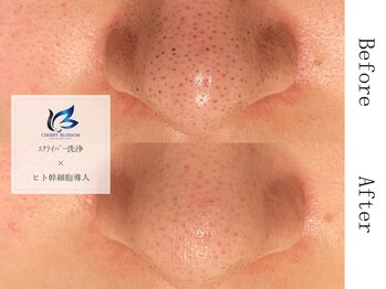 チェリーブロッサム 川越店(CHERRY BLOSSOM)/毛穴洗浄×ヒト幹細胞美容液導入
