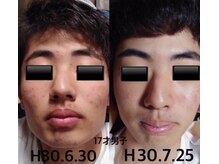 リボーン バイ 中村鍼灸整体院(re born)/ニキビケア　男子基本は洗顔から