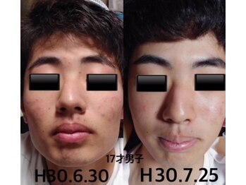 リボーン バイ 中村鍼灸整体院(re born)/ニキビケア 男子基本は洗顔から