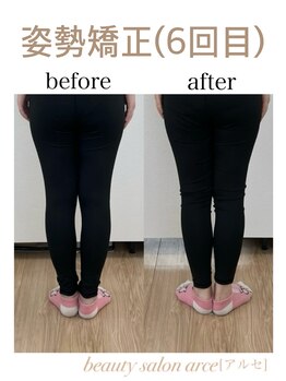 アルセ(arce)/姿勢矯正 膝下O脚改善