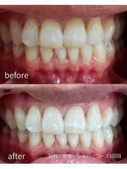 ココホワイトニング(coco whitening)/【30代 女性シルバーコース】