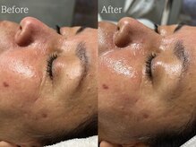 ルミナ シブヤ(LUMINA SHIBUYA)/【ダクトピール】1回目　横顔