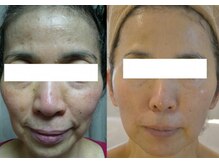 インナーメス(INNER MES)/悩みを丸ごと改善！