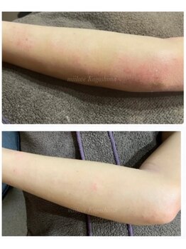 ミーラブ 鹿児島(miilove)/敏感肌専門。肌も綺麗になる脱毛