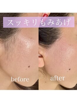 シック(Chic)/マリムーブ(もみあげ)