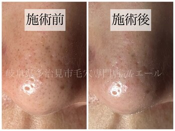 エール(aile)/鼻の黒ずみ撃退！