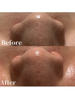 マヴィ(Mavie)/韓国式3D毛穴洗浄