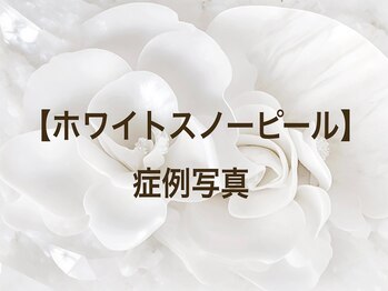 スイ 昭島店(Sui)/ホワイトスノーピール/シミ/美白