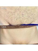 カウピリ(kaupili)/【脱毛】ビフォーアフター