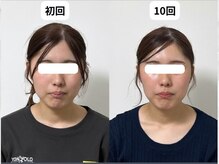 サロンスマイル/20代美容鍼ビフォーアフター