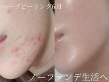 フォア(foi)の雰囲気（REVIのハーブピーリングは国内シェア1位/結果にこだわる方は是非）