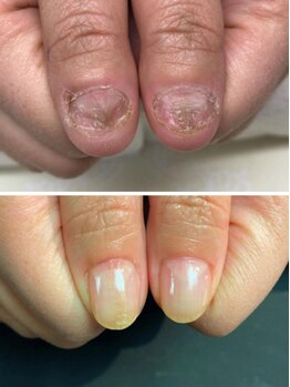 モッチ 神楽坂(mocchi)の写真/ジェルをしないで育成も可能。割れ爪、2枚爪、深爪などのお悩みの方はご相談ください◎