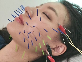 とだ鍼灸院 接骨院の写真/【美容鍼初回3,300円】小顔、むくみ改善、リフトアップ、肌質改善◎キュッと引き締まったハリ艶美肌に♪