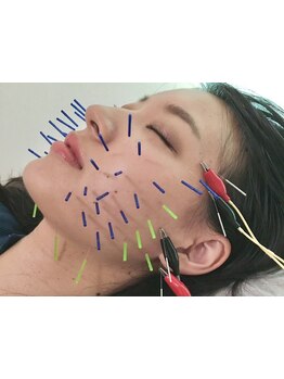 鍼灸施術を受けたい