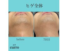 アクト クロ(ACT curro)/【ヒゲ全体】脱毛施術例