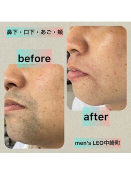 ランドマーク 中崎町(LANDMARK.)/《 口周り・ほほ 》