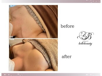 ベルビューティー(belle beauty)/バストアップ◇症例◇