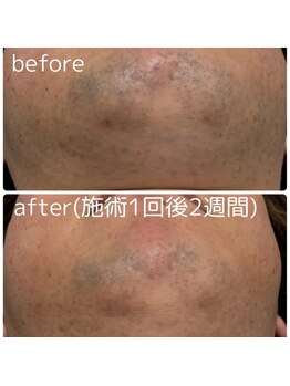 エースビューティーサロン 蒲郡店(ACE. beauty salon)/脱毛1回のビフォーアフター