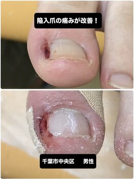 陥入爪による痛み専門矯正で改善