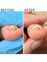 クオッカ(Quokka)/第二趾の巻き爪ケア