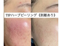 ペルボヌール 深井店/本気の肌質改善ハーブピーリング