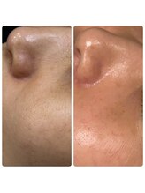 スキンラボ カホクカイ(KaHokuKai)/１回/4週　　２回目　