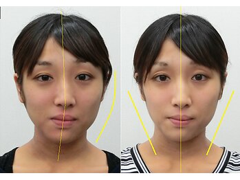 宮崎整体院/【小顔矯正・顔の歪み矯正】