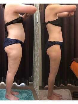 ビーシェイプ 君津(B-Shape)/【痩身】ビフォーアフター