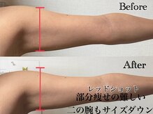 アンドエス 六本木(and S.)/レッドショットで二の腕すっきり