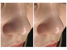 ホワイトアクア 京橋店(WHITE AQUA)/毛穴洗浄×引き締めケア1回