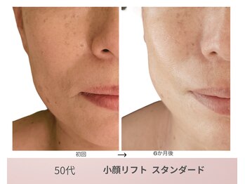 リアン(Lien)の写真/【見た目マイナス5歳】深部から引き上がる小顔リフト|二重アゴ・たるみ改善&目元もぱっちり若見えへ