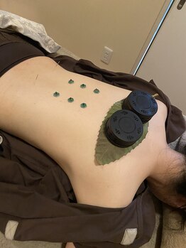 カジコ(kajico)の写真/痛みが苦手な方にも☆深く刺し過ぎない優しい施術。女性鍼灸師が根本から美しさを引き出す本格アプローチ♪