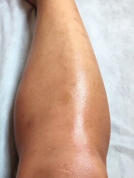 ベルヴィー(Belle vie)/メンズ脚脱毛