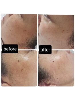 ソラ(sora)/ハイドロ・毛穴の症例★