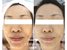 アロマアンドフェイシャルサロン &nbsp;エメシェリー(aimercherie)/荒れやすいお肌のキメを整えます