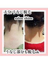 サロンシャイン(Salon Shine)/うなじ脱毛２０代前半女性