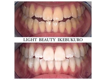 ライトビューティー 池袋店(LightBeauty)/症例写真