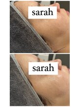 サラ(Sarah)/ハーブピーリングrevi