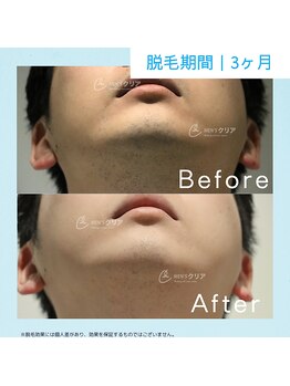 メンズクリア 横浜駅前店/【メンズクリア】お客様の施術例