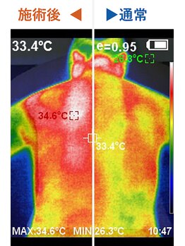 レポリア(Reporia)/施術後の体温変化