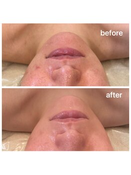 ステージ(Stage)/毛穴洗浄・ハイドラフェイシャル