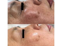 サロン ルポ(salon Repo)/【シミシワ改善ケア