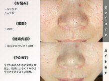 ルディラ 大宮店/水玉グロウリフト(韓国式LDM)