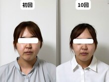 サロンスマイル/20代美容鍼ビフォーアフター