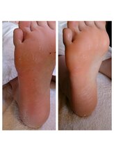 フットスタジオ アルク(FOOT STUDIO ALUK)/【角質ケア保湿パック３０分】