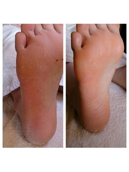 フットスタジオ アルク(FOOT STUDIO ALUK)/【角質ケア保湿パック30分】