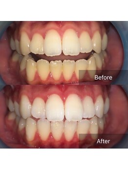 メンズ脱毛 リボーン(reborn)/1回でここまで変わる