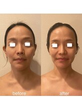 エミナル(EMINALu)/左右差解消