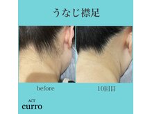 アクト クロ(ACT curro)/【うなじ襟足】脱毛施術例