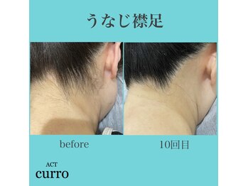 アクト クロ(ACT curro)/【うなじ襟足】脱毛施術例